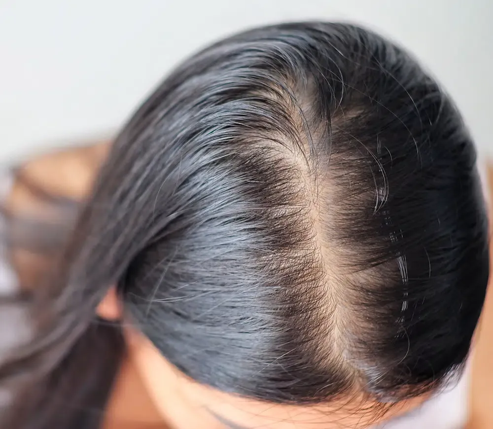 Hair Fall Control and Regrowth Treatment in Wagholi Pune